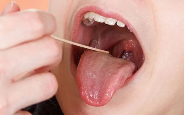 Điều trị ung thư vòm họng giai đoạn đầu tùy thuộc vào tình hình bệnh lý của người bệnh