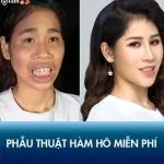 Kinh nghiệm phẫu thuật hàm hô miễn phí sau 30 ngày phục hồi của cô gái khỉ đột