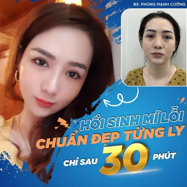 Hướng Dẫn Cách Làm Tan Máu Bầm Ở Mí Mắt