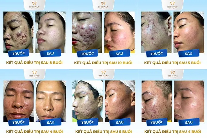 Trị mụn trước và sau