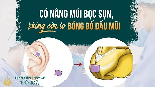 Nâng mũi bằng sụn tai bao nhiêu? Chi phí giúp kết quả duy trì vĩnh viễn - Hình 4